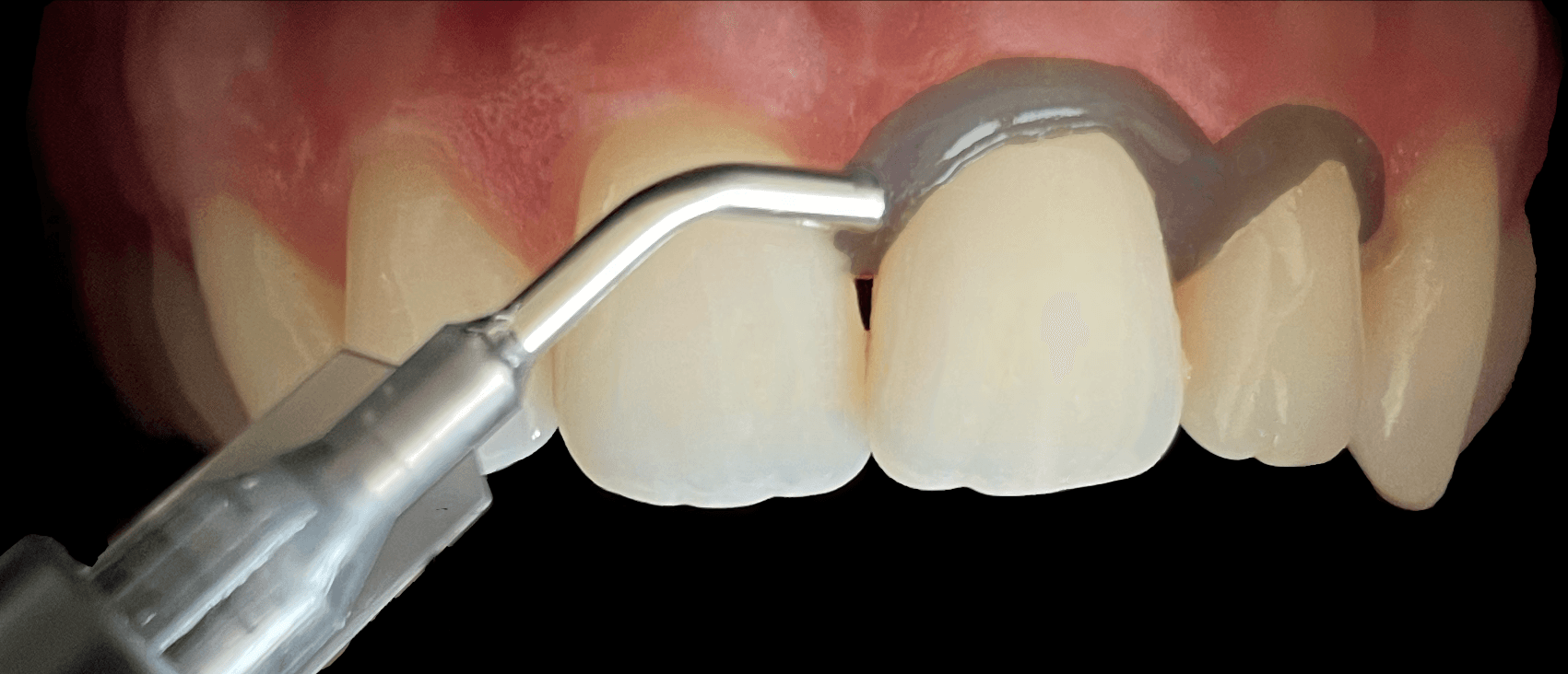 FlexBarrier applied along the gingival margin during a clinical procedure